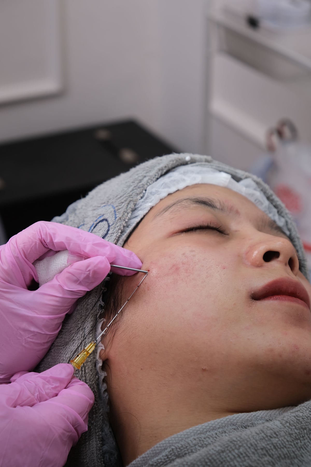 Microneedling-behandling af huden – solide vs. hule nåle – Trondahl Skincare