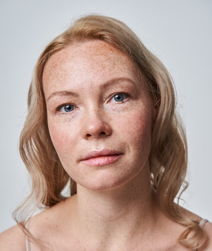 Microneedling mod rynker og fine linjer – realistiske resultater – Trondahl Skincare
