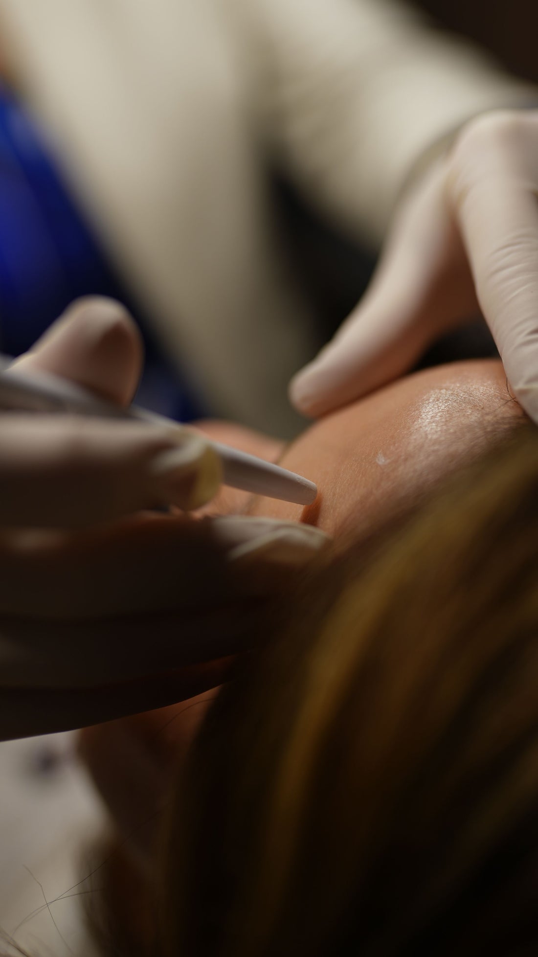 Kosmetisk hudbehandling i klinik – overbehandlet hud efter microneedling – Trondahl Skincare