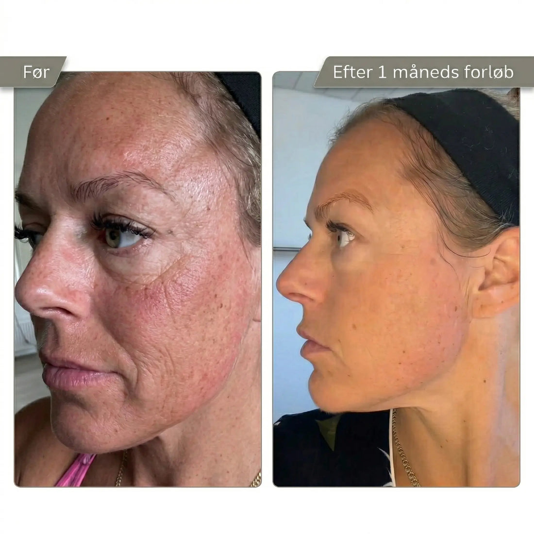 Micro Infusion Kit Trondahl skincare