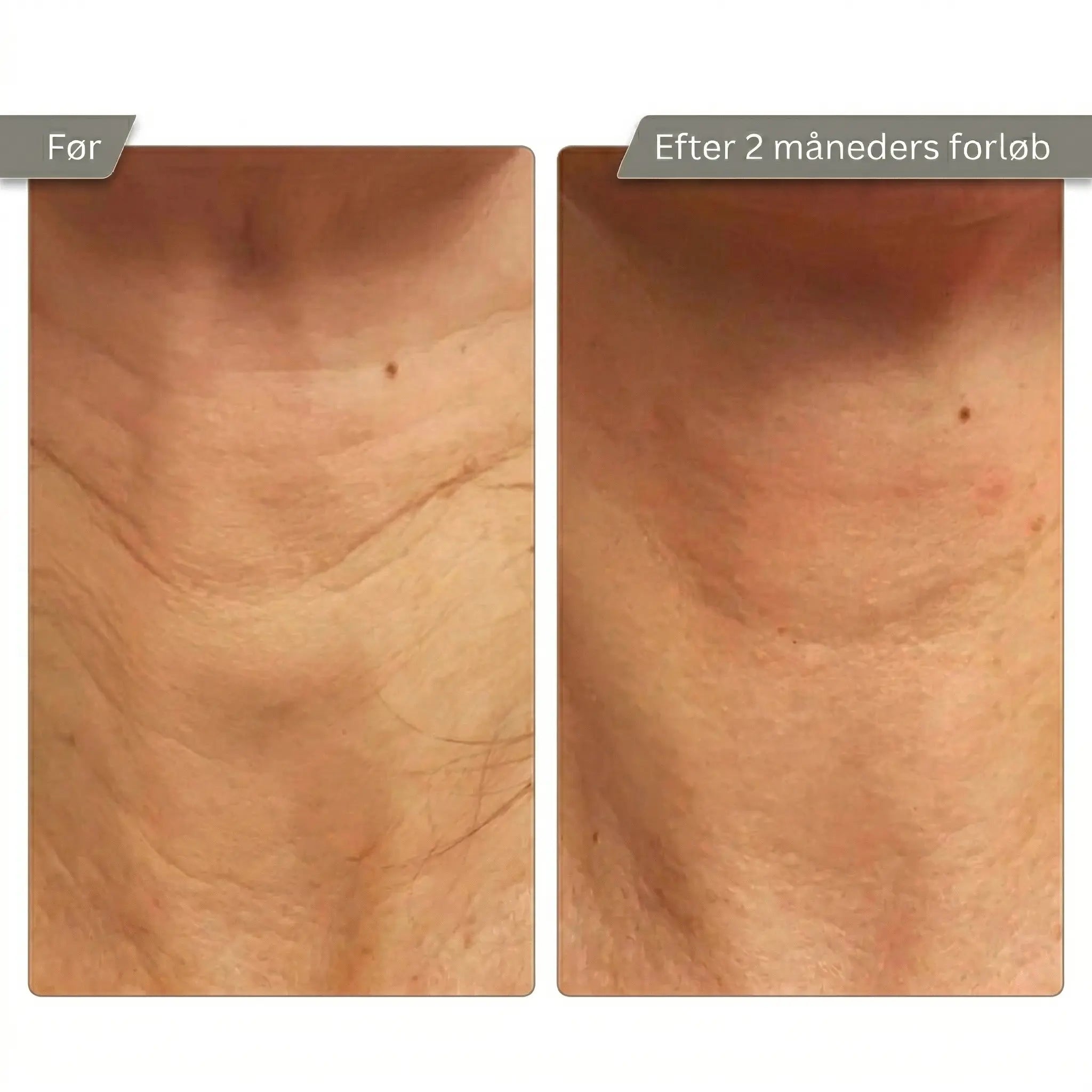 Micro Infusion Kit Trondahl skincare