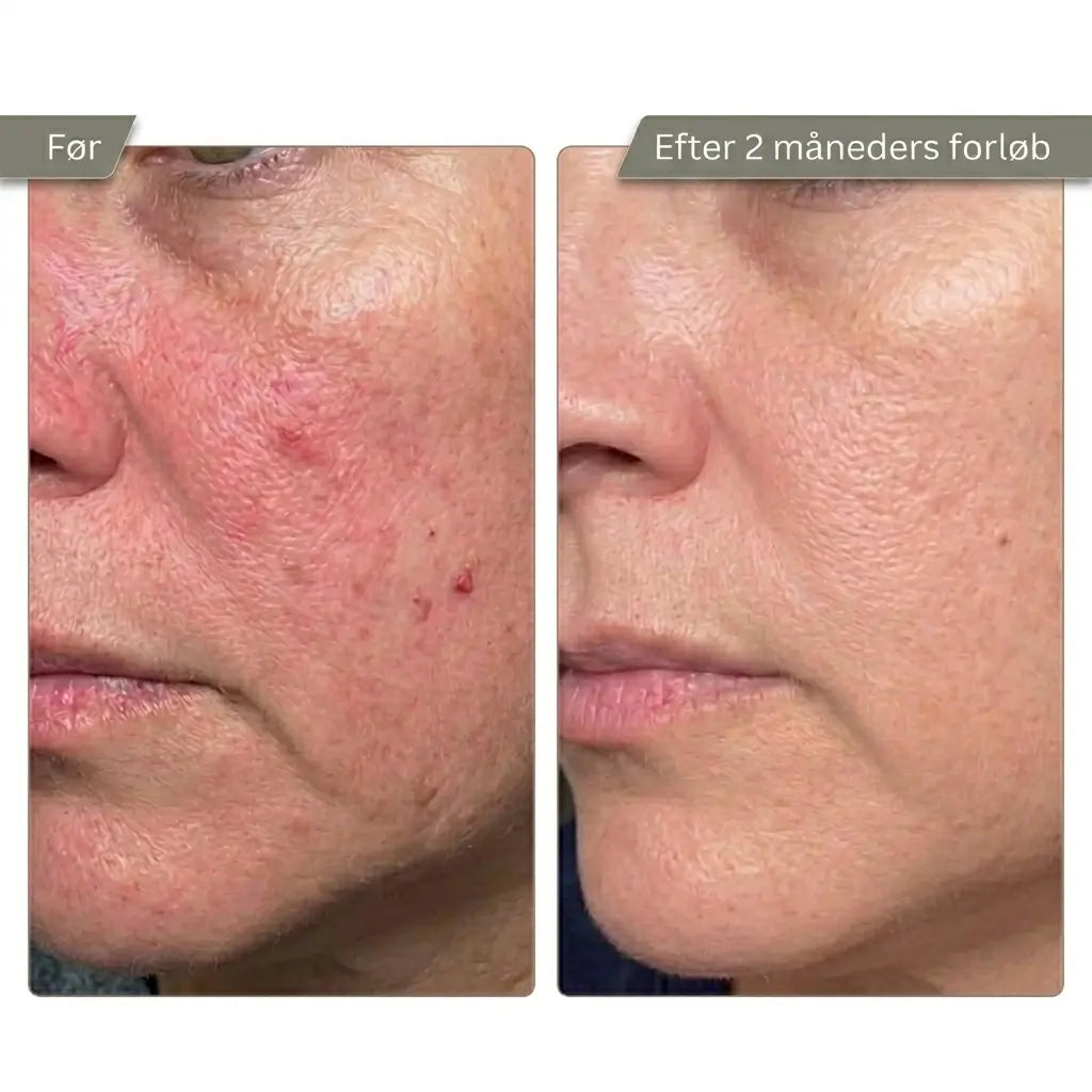 Micro Infusion Kit Trondahl skincare