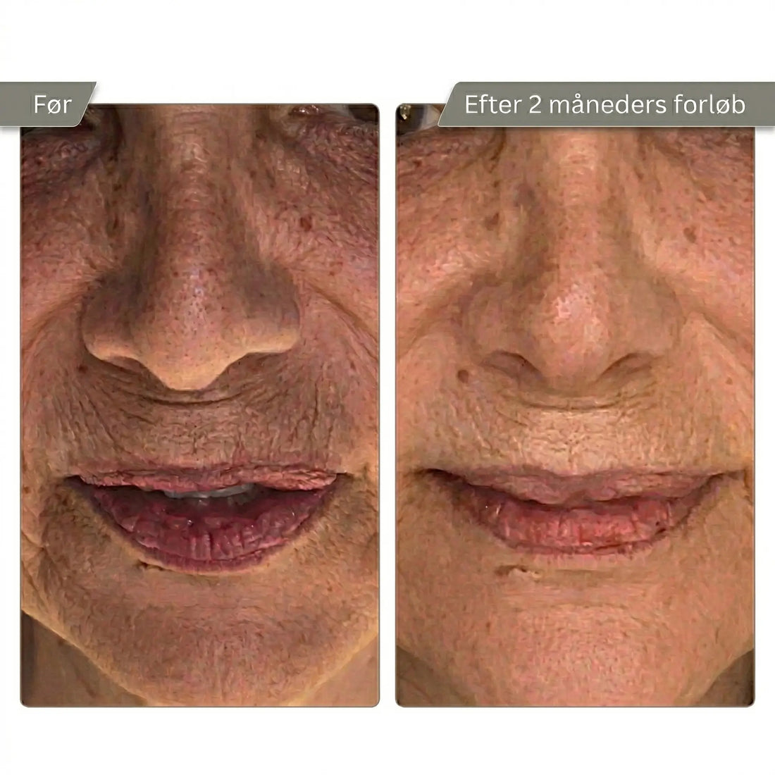 Micro Infusion Kit Trondahl skincare