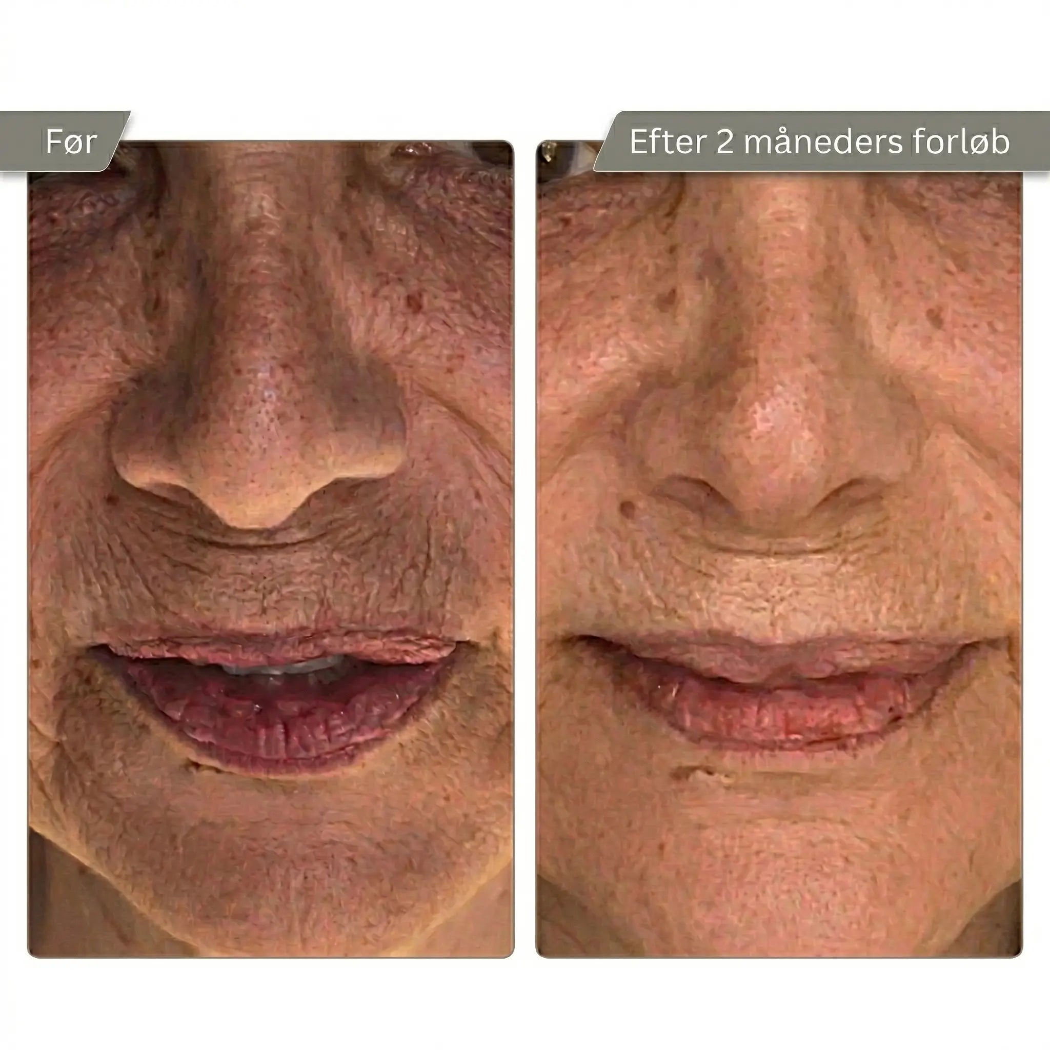 Micro Infusion Kit Trondahl skincare