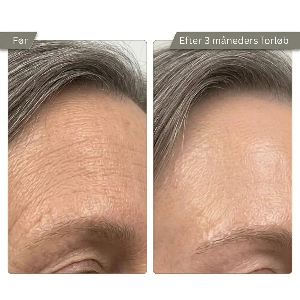 Micro Infusion Kit Trondahl skincare