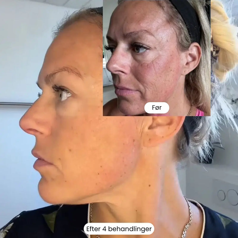 Micro Infusion Kit Trondahl skincare